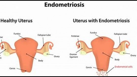 Endometriosis In Jamaica: Call For Greater Public Awareness, Support ...